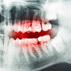 Dental X-Ray