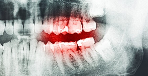 Dental X-Ray