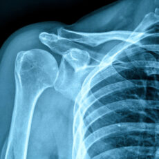 Fracture in x-ray