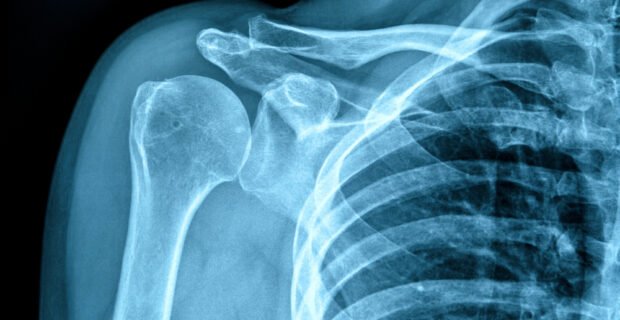Fracture in x-ray